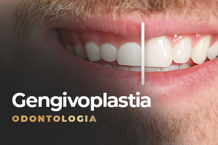 gengivoplastia na sena select